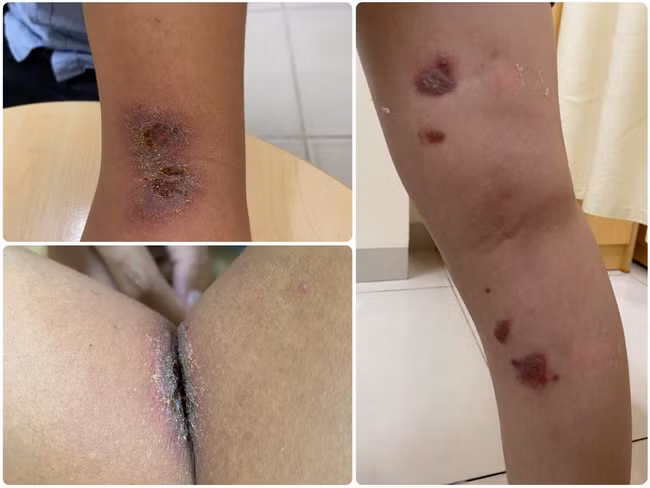 Bác sĩ da liễu khuyến cáo cách phòng tránh, điều trị viêm da do nọc độc kiến ba khoang ảnh 2