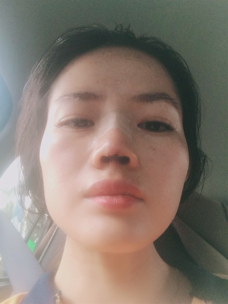 Sau phẫu thuật, phần mũi bị can thiệp của chị Vân bị hoại tử.