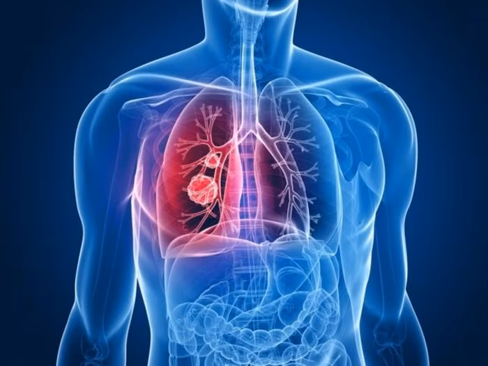 Không hút thuốc vì sao nhiều người vẫn mắc ung thư phổi?