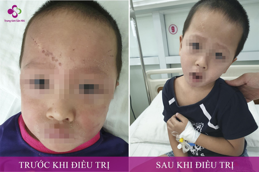 Dấu hiệu hội chứng bong vảy da do tụ cầu ở trẻ ảnh 1 Dấu hiệu hội chứng bong vảy da do tụ cầu ở trẻ ảnh 1
