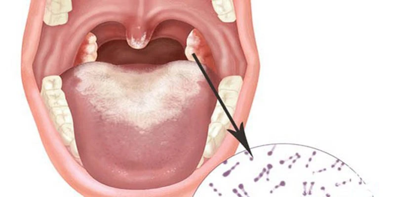 Hà Nội: Tăng cường công tác phòng chống tay chân miệng và bạch hầu