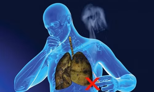 Hút thuốc lá, nguy cơ mắc ung thư phổi cao gấp hàng chục lần