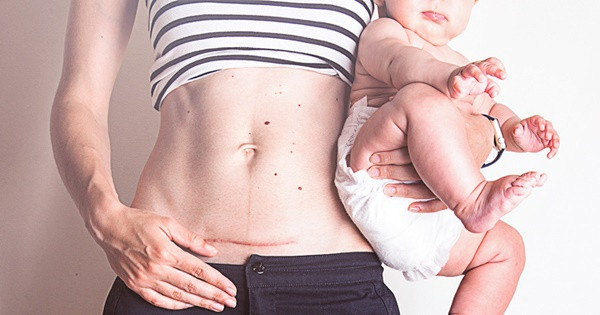 Những di chứng kéo dài sau sinh mổ Những di chứng kéo dài sau sinh mổ
