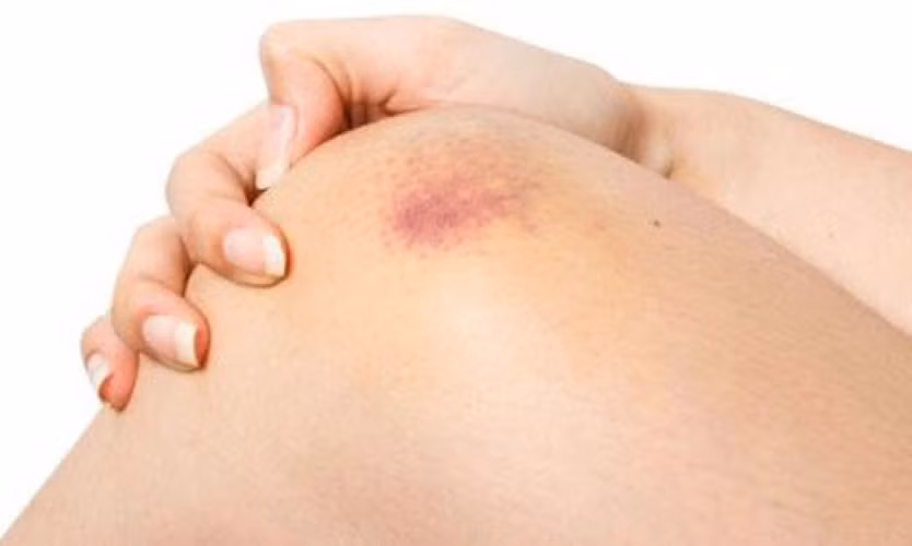 Mẹo giúp bạn xóa vết bầm tím chỉ trong 1 ngày ảnh 1