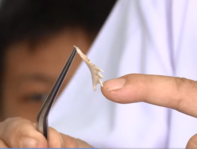 Cách xử lý hiệu quả ngay khi bị hóc xương cá ảnh 5