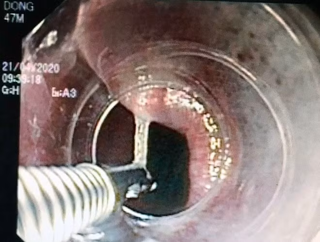 Cách xử lý hiệu quả ngay khi bị hóc xương cá ảnh 1