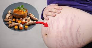 Cách trị rạn da bằng nghệ vừa rẻ lại hiệu quả bất ngờ Cách trị rạn da bằng nghệ vừa rẻ lại hiệu quả bất ngờ