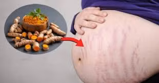 Cách trị rạn da bằng nghệ vừa rẻ lại hiệu quả bất ngờ