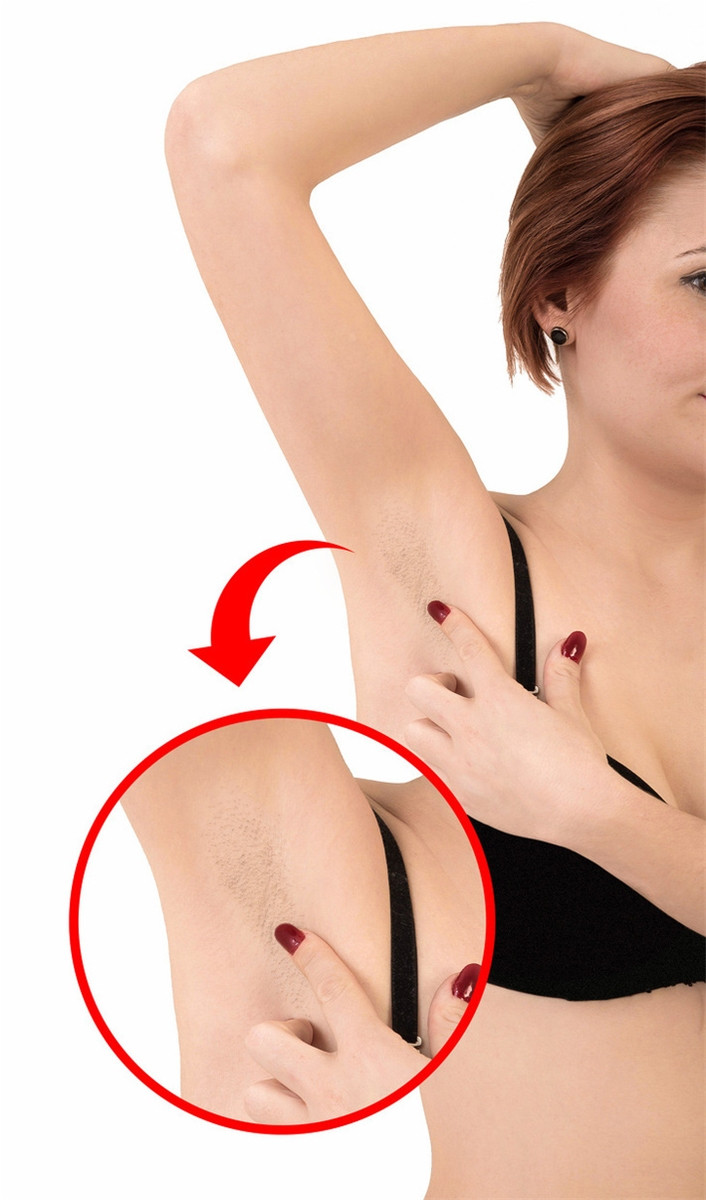 Cẩn thận với những cách tẩy lông sai khiến làn da tổn thương ảnh 4 Cẩn thận với những cách tẩy lông sai khiến làn da tổn thương ảnh 4