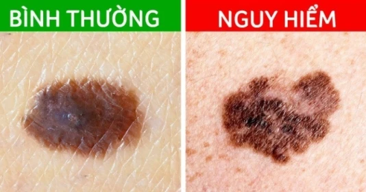 6 dấu hiệu nhận biết sớm nốt ruồi ác tính