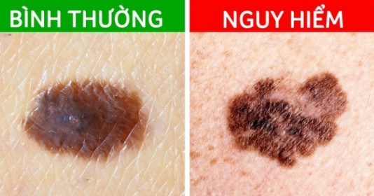6 dấu hiệu nhận biết sớm nốt ruồi ác tính