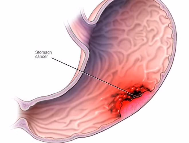 Cảnh báo 10 thói quen xấu gây ung thư dạ dày ảnh 15