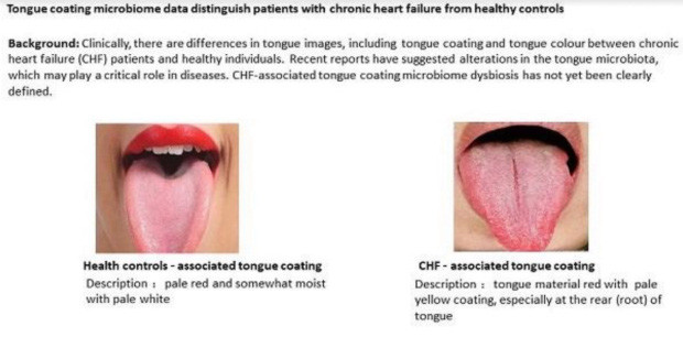 Dấu hiệu ở lưỡi cảnh báo bệnh tim nguy hiểm