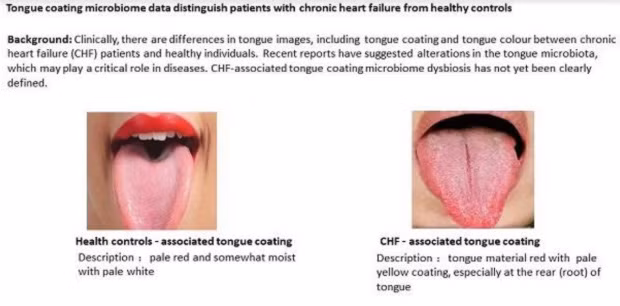 Dấu hiệu ở lưỡi cảnh báo bệnh tim nguy hiểm