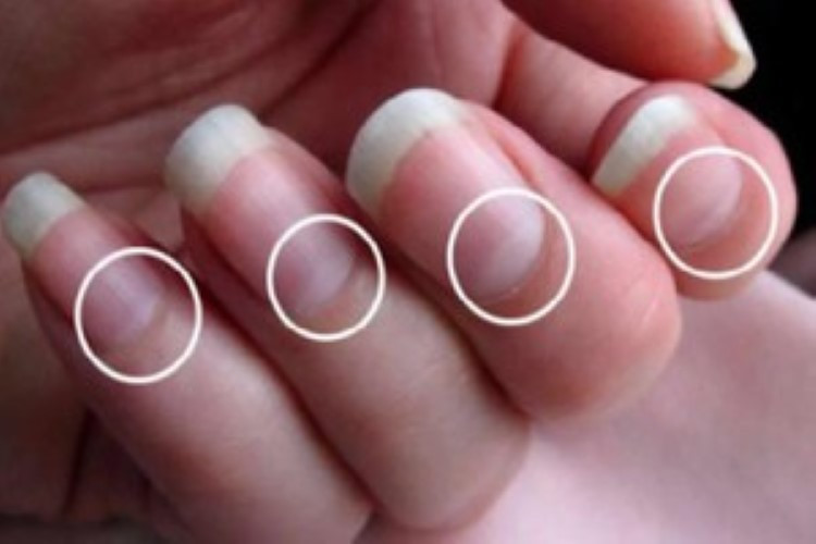 Nhìn hình dạng liềm móng tay dự đoán chính xác vấn đề về sức khỏe 