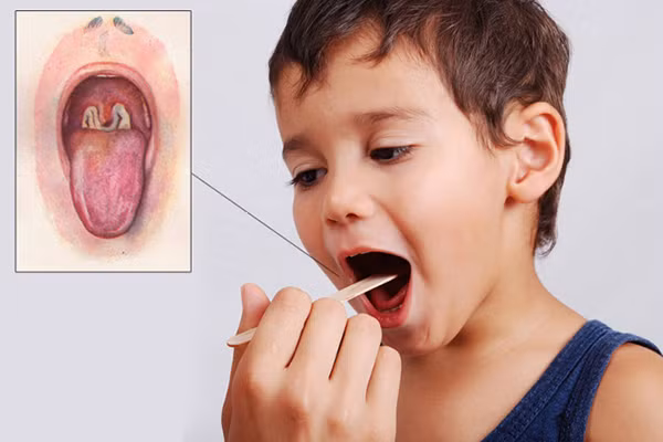 Dịch bạch hầu tăng gấp 3 lần năm trước, Bộ Y tế họp khẩn ảnh 1