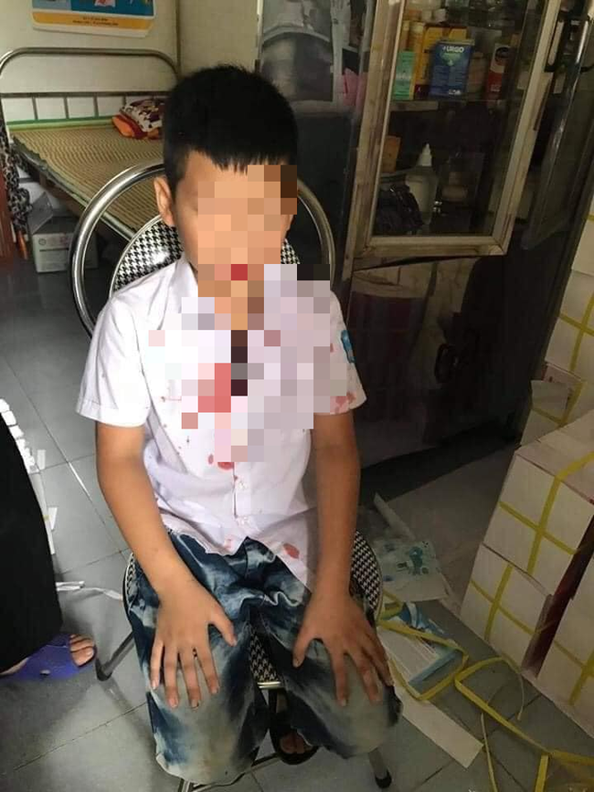 Bé trai lớp 1 bị phụ huynh của bạn xông vào trường hành hung dã man ảnh 1 Bé trai lớp 1 bị phụ huynh của bạn xông vào trường hành hung dã man ảnh 1