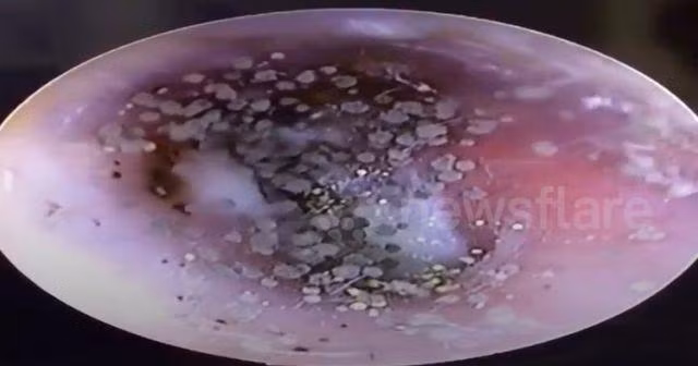 Cậu bé 10 tuổi mọc cả cụm nấm đen trong tai từ thói quen nhiều người mắc ảnh 1