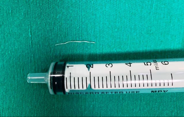 Gắp sợi kim loại nằm 3 tháng trong cổ bệnh nhi 8 tháng tuổi