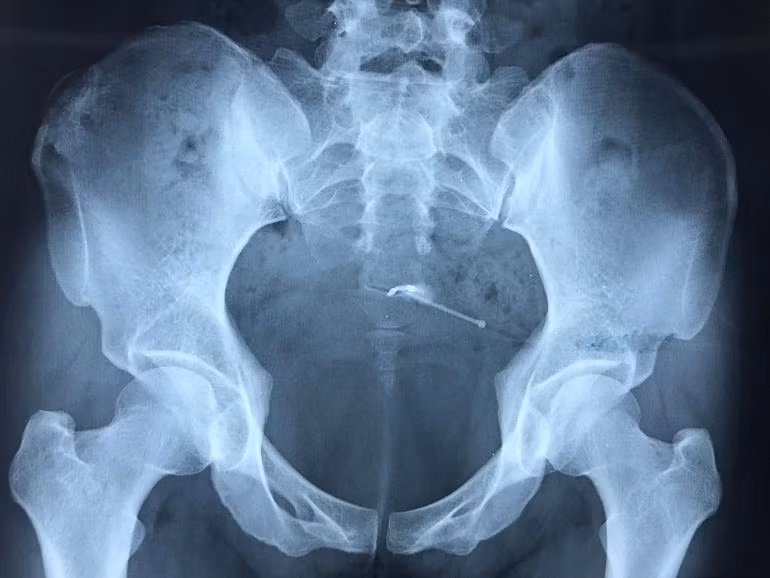 Phẫu thuật sỏi bàng quang, bất ngờ phát hiện vòng tránh thai “đi lạc” ảnh 1