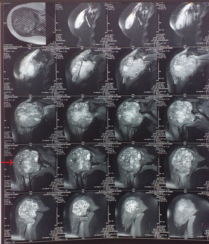 Cô gái mang bướu xương khổng lồ vì tin thầy lang ảnh 1 Cô gái mang bướu xương khổng lồ vì tin thầy lang ảnh 1