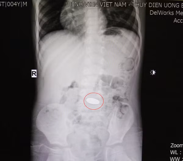 Nuốt đồng xu vào bụng, bệnh nhi 5 tuổi được cấp cứu kịp thời ảnh 1