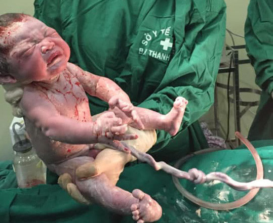 Phẫu thuật thành công đưa thai nhi bị dây rau thắt nút ra ngoài