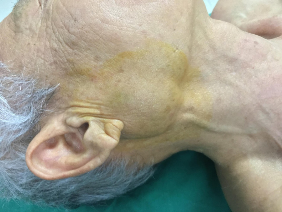 Phẫu thuật thành công cho bệnh nhân bị u tuyến nước bọt mang tai Phẫu thuật thành công cho bệnh nhân bị u tuyến nước bọt mang tai