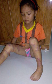 Quảng Bình: Bé gái 8 tuổi bị đòn roi tàn bạo từ bố đẻ ảnh 3 Quảng Bình: Bé gái 8 tuổi bị đòn roi tàn bạo từ bố đẻ ảnh 3