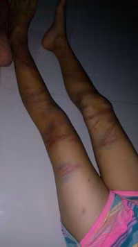 Quảng Bình: Bé gái 8 tuổi bị đòn roi tàn bạo từ bố đẻ ảnh 4