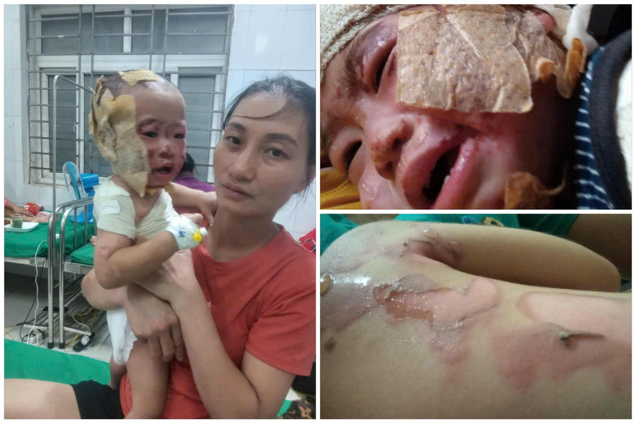 Bị ngã vào nồi canh đang sôi khiến bé Như Quỳnh bỏng nặng. 7e41abd58ed53a8b63c4.jpg