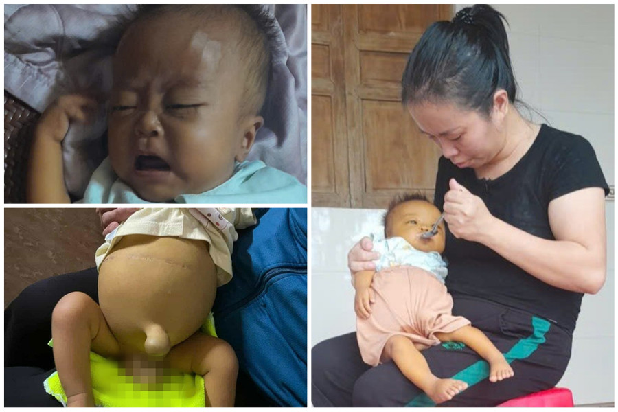 Mới 7 tháng tuổi, bé Phong phải chịu quá nhiều nỗi đau về thể xác.