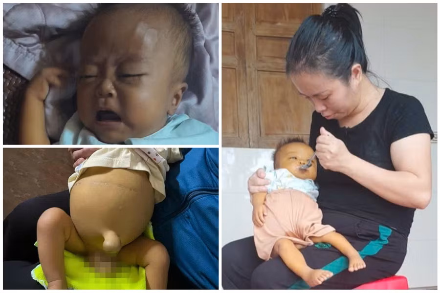 Mới 7 tháng tuổi, bé Phong phải chịu quá nhiều nỗi đau về thể xác.