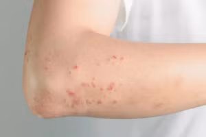 Sởi có thể dẫn đến các biến chứng nghiêm trọng. Ảnh minh hoạ. 