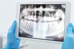 Trong quá trình phẫu thuật, bác sĩ đã nhổ nhầm một chiếc răng khỏe mạnh của bệnh nhân. Ảnh minh hoạ.