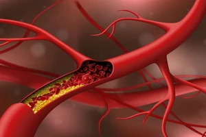 Một đánh giá năm 2019 cho thấy, ăn các loại đậu giúp giảm mức cholesterol.