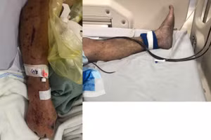 Bệnh nhân được chẩn đoán sốc nhiễm khuẩn - nhiễm khuẩn huyết - viêm phổi, trên nền tăng huyết áp, tiên lượng tử vong rất cao. Ảnh: BVCC. 