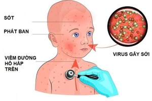 Nếu không được phát hiện sớm và điều trị kịp thời, bệnh sởi có thể gây những biến chứng nguy hiểm.