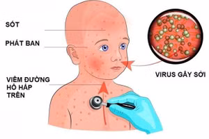 Nếu không được phát hiện sớm và điều trị kịp thời, bệnh sởi có thể gây những biến chứng nguy hiểm.