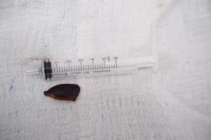 Dị vật được gắp ra khỏi phế quản người bệnh. Ảnh: BVCC. 