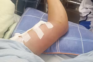 Bệnh nhân Whitmore bị sưng đau, áp xe tay trái, ổ vi khuẩn vào tận xương. Ảnh: BVCC. 