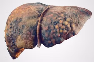 Có nhiều nguyên nhân gây xơ gan. Trong đó, xơ gan do rượu chiếm 10 - 20%. Ảnh minh hoạ. 