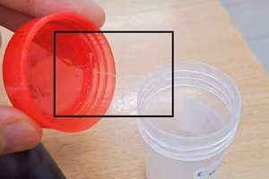 Các bác sĩ đã lấy ký sinh trùng ra an toàn trong điều kiện vô trùng. Ảnh: BVCC. 