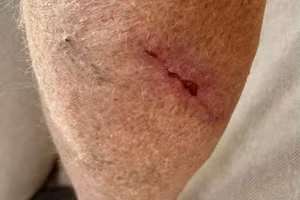 Ông Chris Long đã được phẫu thuật loại bỏ u hắc tố ác tính. 