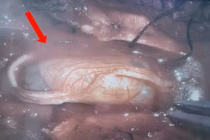 Hình ảnh khối u tuỷ trong ống sống ngực đoạn ngang T6T7 kích thước (1,5 x 2 cm) của bệnh nhân. Ảnh: BVCC. 