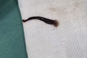 Các bác sĩ tiến hành nội soi và phát hiện một con vắt lớn bám chặt vào thành khoang mũi của trẻ.