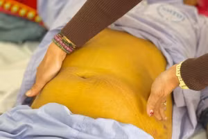 Bệnh nhân được chẩn đoán mắc suy gan cấp, xơ gan, viêm gan B mạn tính, hôn mê gan độ 2. Ảnh: BVCC. 