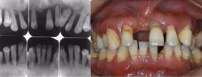 Người đàn ông 31 tuổi đi khám vì răng lung lay, nhưng bác sĩ lại nhổ tất cả răng vì sai lầm từ 2 năm trước của anh - Ảnh 4.