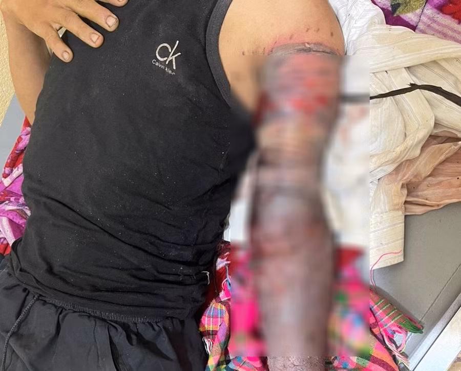 Cánh tay bệnh nhân T. sau khi nhập viện. Ảnh: BVCC.