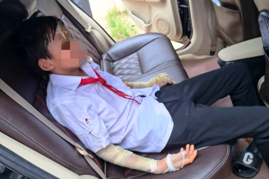 Một học sinh Trường Tiểu học Yên Phú (Yên Định, Thanh Hóa) bị thương do nổ bóng bay. Ảnh. Bạn đọc cung cấp.